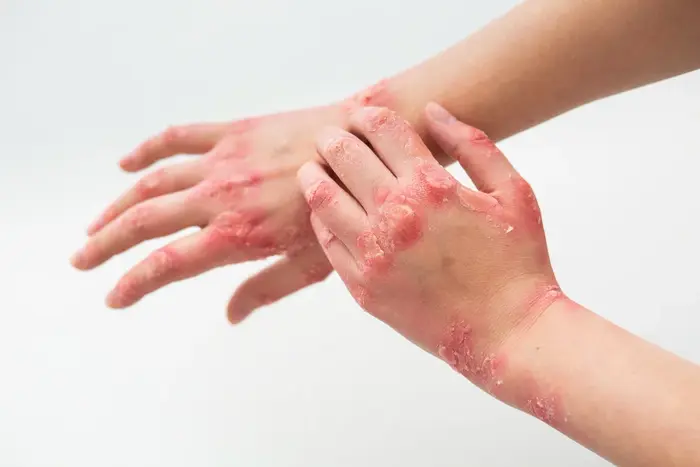 Ayurvedic Psoriasis Treatment in India | Arogyadham