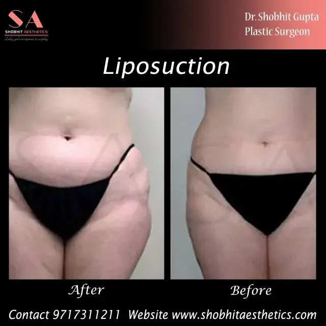 Get Rid of Belly Fat - Liposuction Surgery in Delhi | #1 Vaser Liposuction Clinic